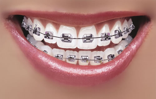Metal Braces