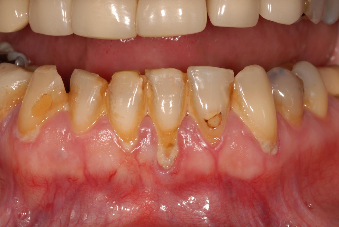 Gums Treatment