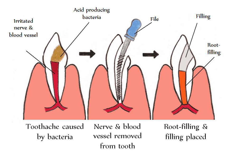 Root Canal Procedure